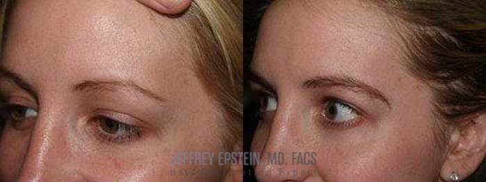 Before & After Eyebrow Transplant Case 336 View 2 View in Miami, FL