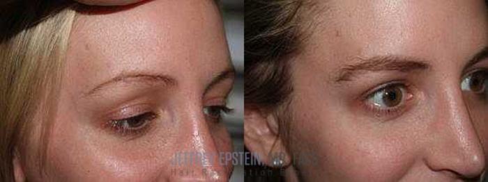 Before & After Eyebrow Transplant Case 336 View 3 View in Miami, FL