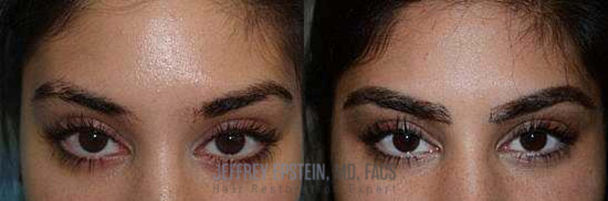 Before & After Eyebrow Transplant Case 337 View 1 View in Miami, FL