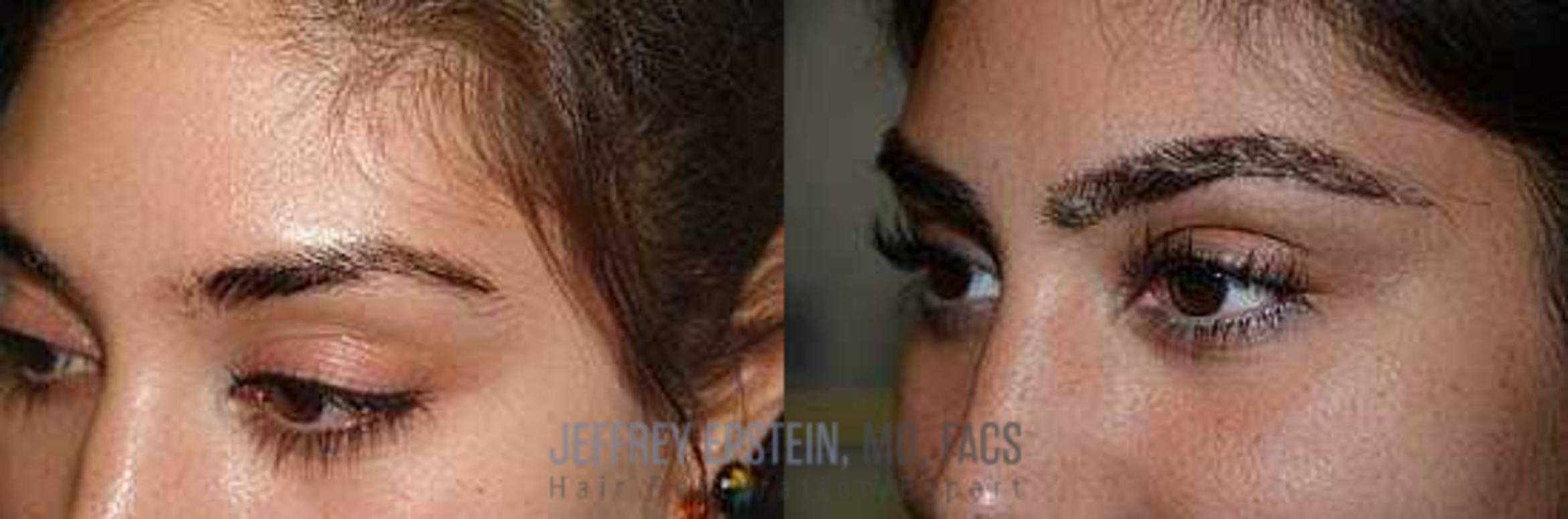 Before & After Eyebrow Transplant Case 337 View 2 View in Miami, FL
