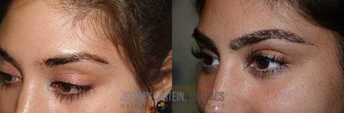 Before & After Eyebrow Transplant Case 337 View 2 View in Miami, FL