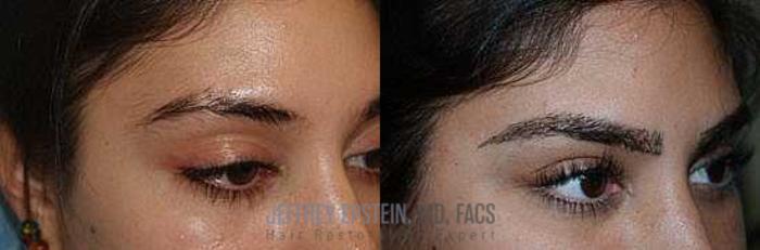 Before & After Eyebrow Transplant Case 337 View 3 View in Miami, FL