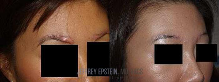 Before & After Eyebrow Transplant Case 338 View 1 View in Miami, FL