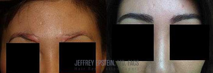 Before & After Eyebrow Transplant Case 338 View 2 View in Miami, FL