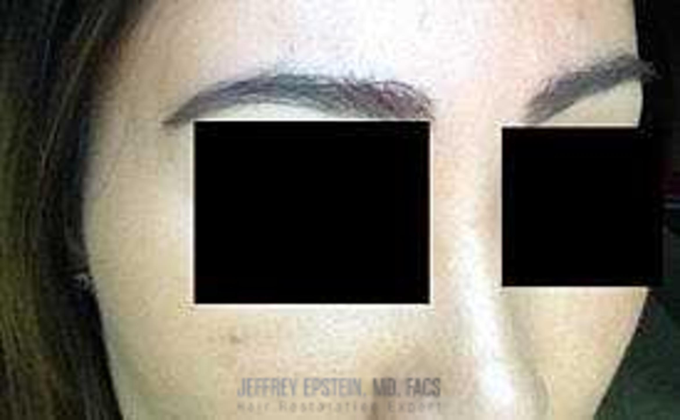 Before & After Eyebrow Transplant Case 338 View 3 View in Miami, FL