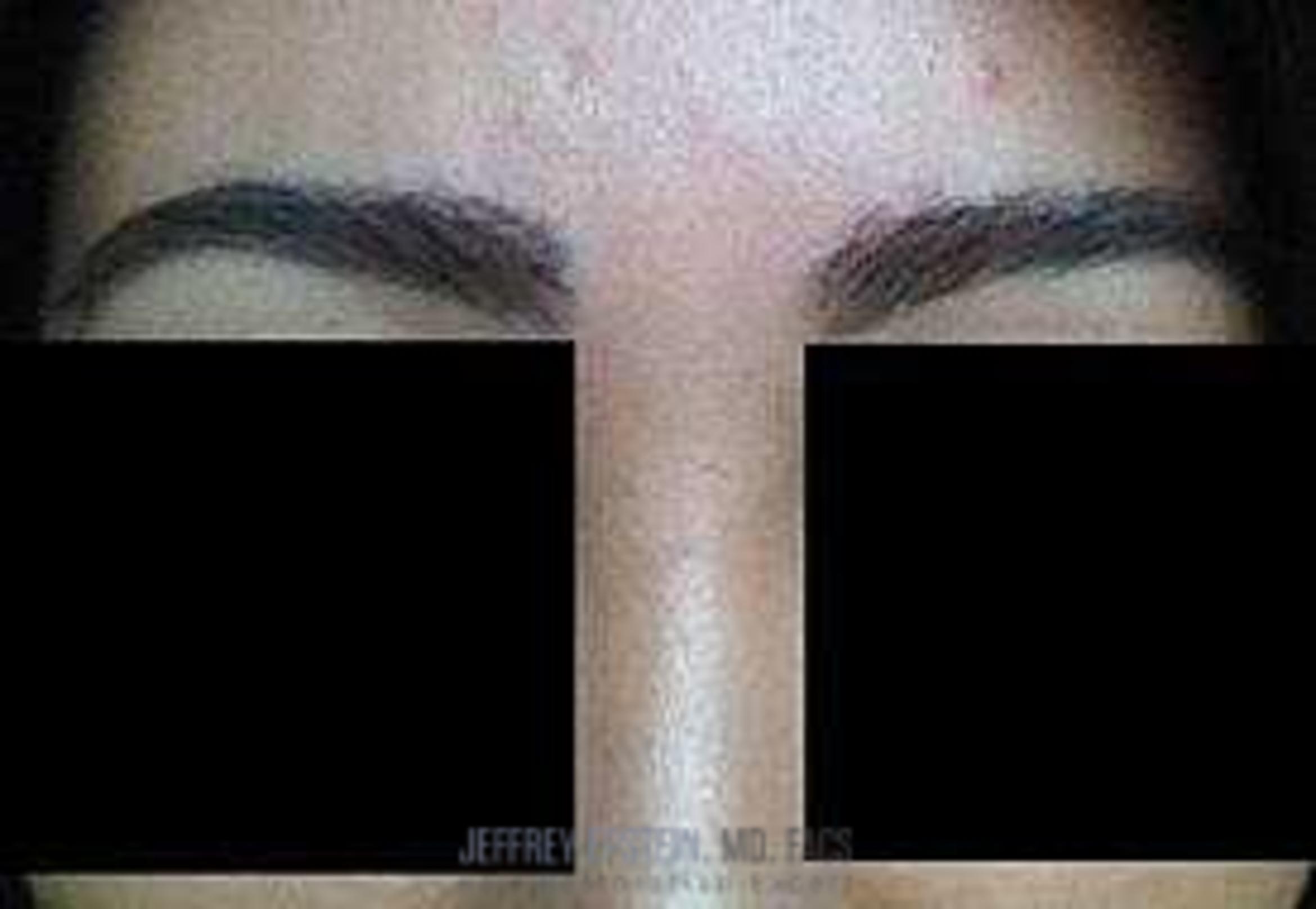 Before & After Eyebrow Transplant Case 338 View 4 View in Miami, FL