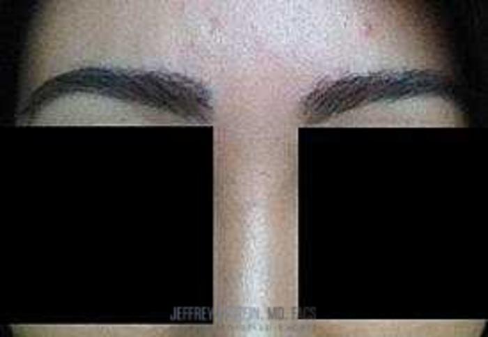 Before & After Eyebrow Transplant Case 338 View 4 View in Miami, FL