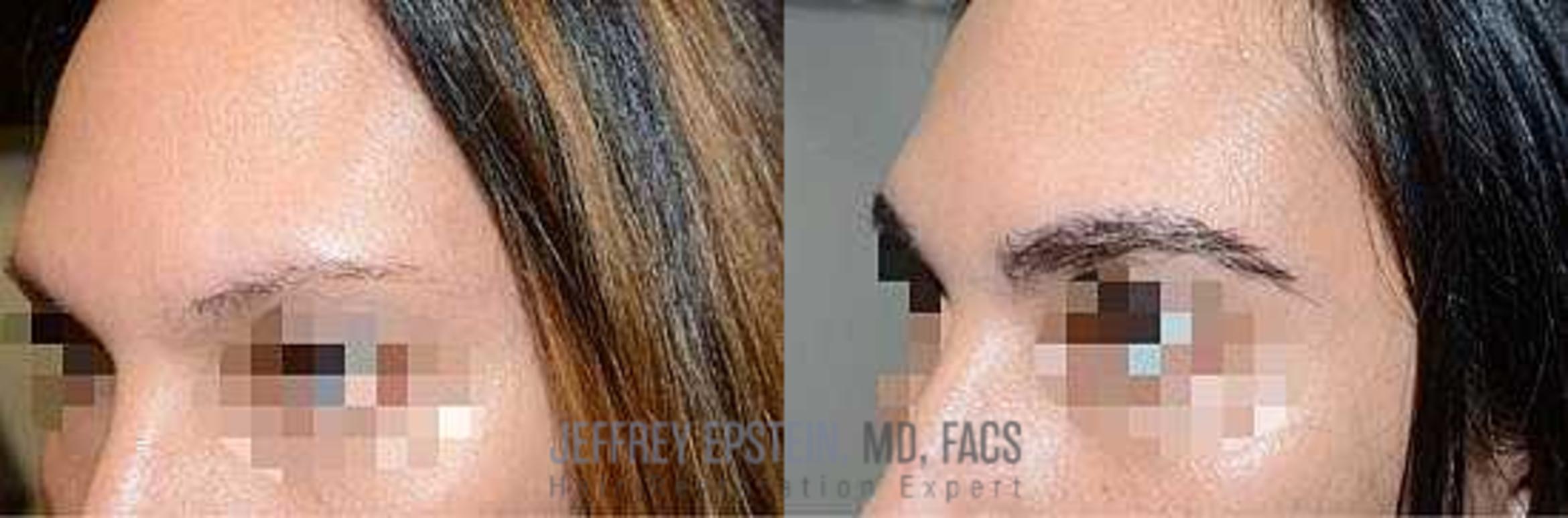 Before & After Eyebrow Transplant Case 339 View 2 View in Miami, FL