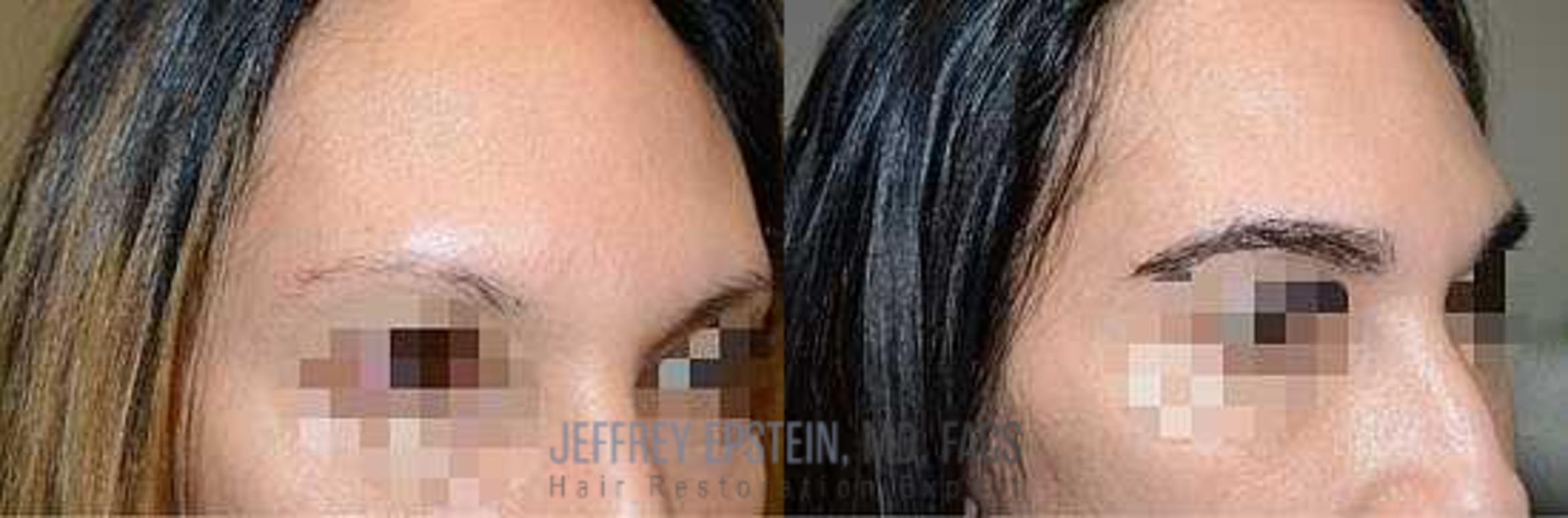 Before & After Eyebrow Transplant Case 339 View 3 View in Miami, FL
