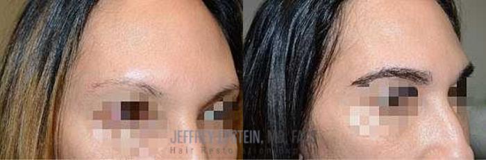 Before & After Eyebrow Transplant Case 339 View 3 View in Miami, FL