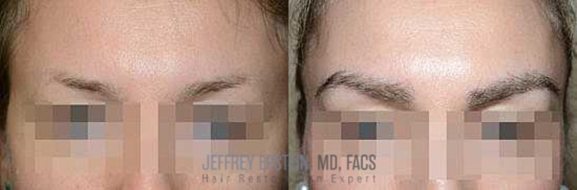 Before & After Eyebrow Transplant Case 340 View 1 View in Miami, FL