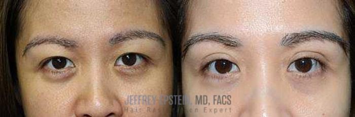 Before & After Eyebrow Transplant Case 341 View 1 View in Miami, FL