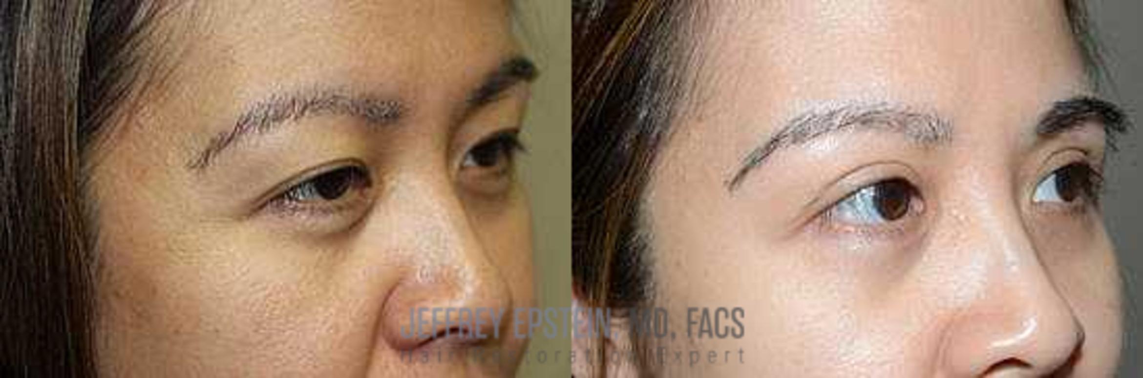 Before & After Eyebrow Transplant Case 341 View 2 View in Miami, FL