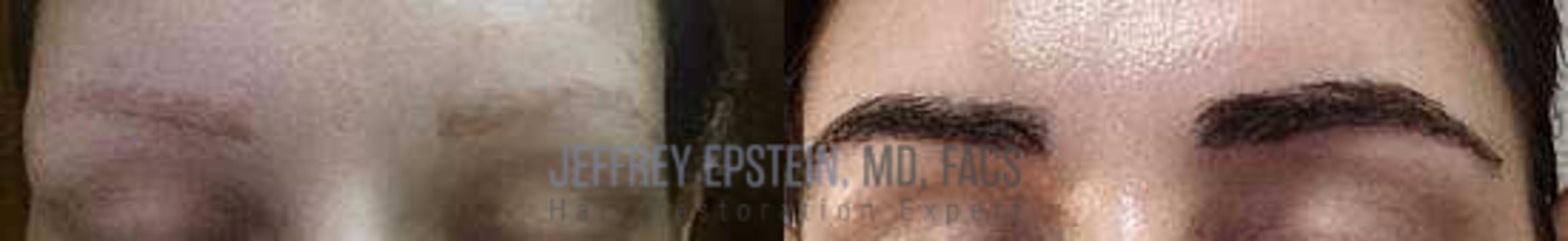 Before & After Eyebrow Transplant Case 343 View 1 View in Miami, FL