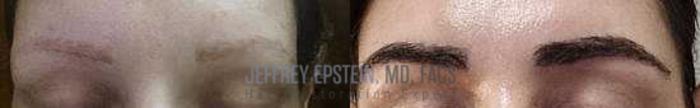Before & After Eyebrow Transplant Case 343 View 1 View in Miami, FL