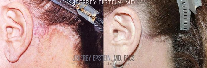 Before & After Facelift & Scar Repair Case 420 Left Side View in Miami, FL