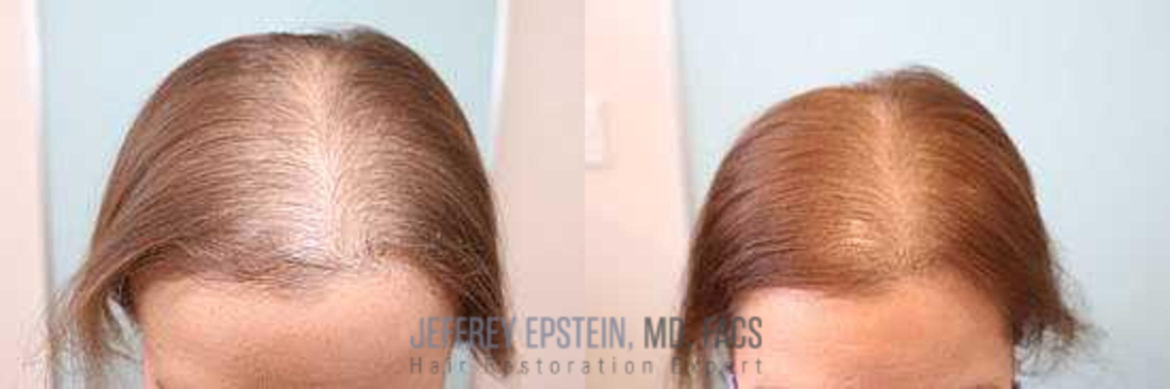 Before & After Hair Loss Medication Case 413 View 1 in Miami, FL