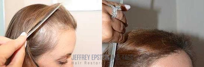 Before & After Hair Loss Medication Case 413 View 2 View in Miami, FL