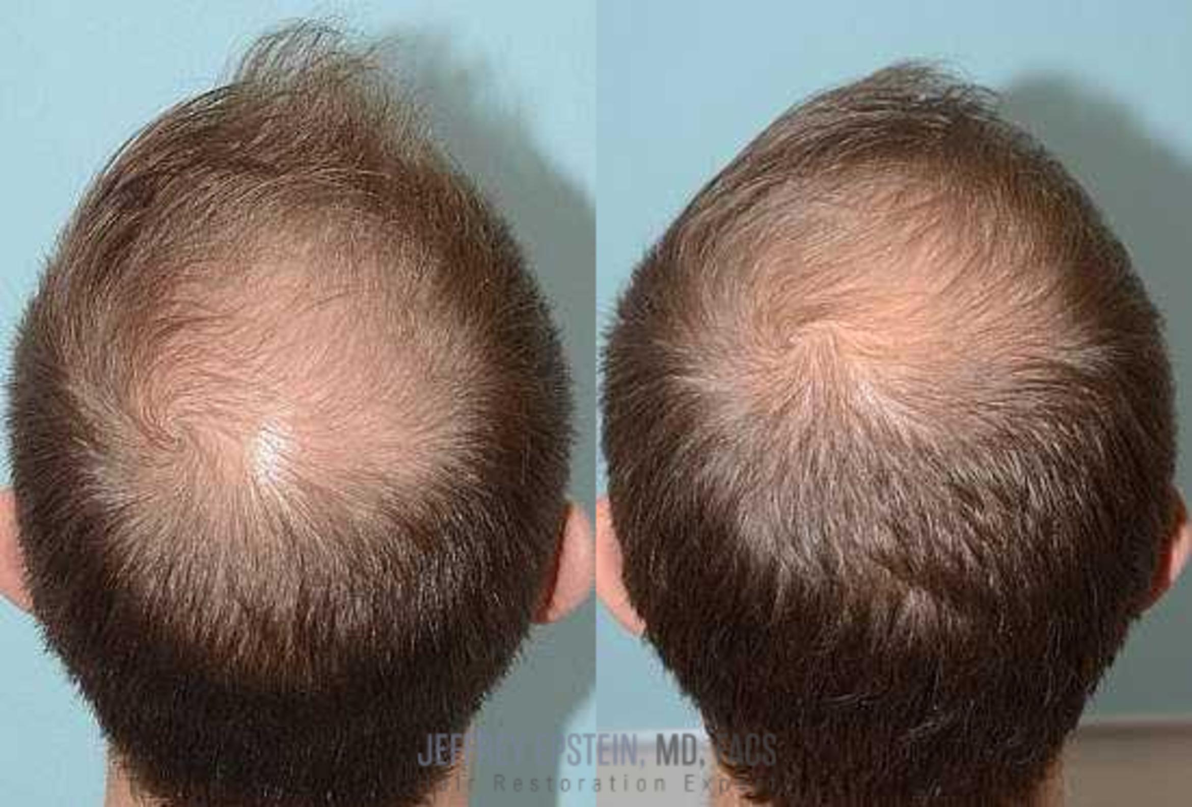 Before & After Hair Loss Medication Case 416 View 1 View in Miami, FL