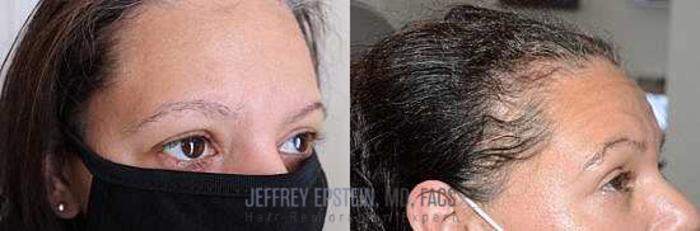 Before & After Hair Loss Medication Case 417 View 2 View in Miami, FL