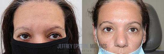 Before & After Hair Loss Medication Case 417 View 3 View in Miami, FL