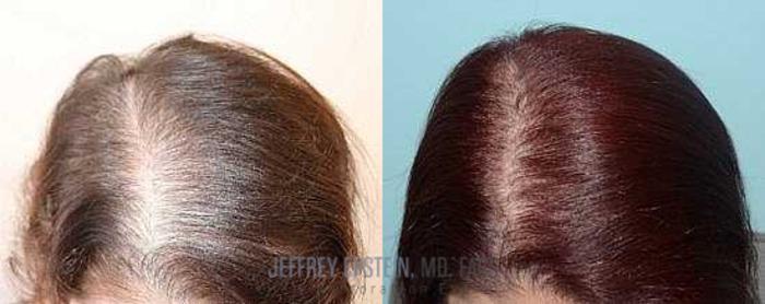 Before & After Hair Red Light Therapy Case 418 View 1 View in Miami, FL