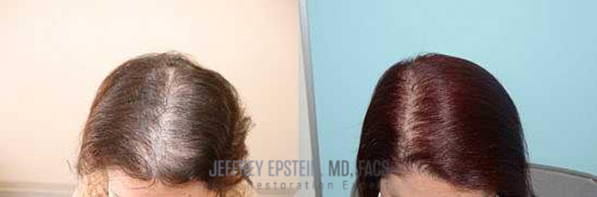 Before & After Hair Red Light Therapy Case 418 View 2 View in Miami, FL