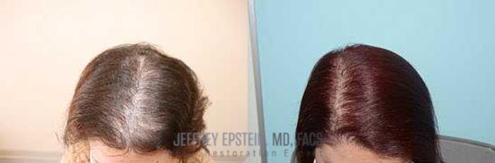 Before & After Hair Red Light Therapy Case 418 View 2 View in Miami, FL