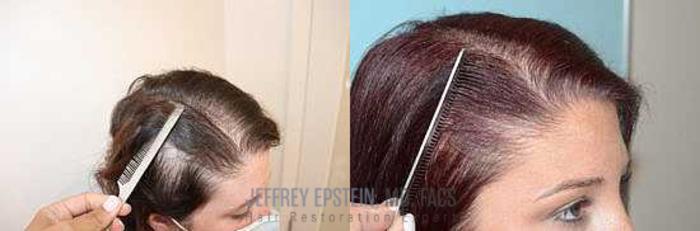 Before & After Hair Red Light Therapy Case 418 View 3 View in Miami, FL