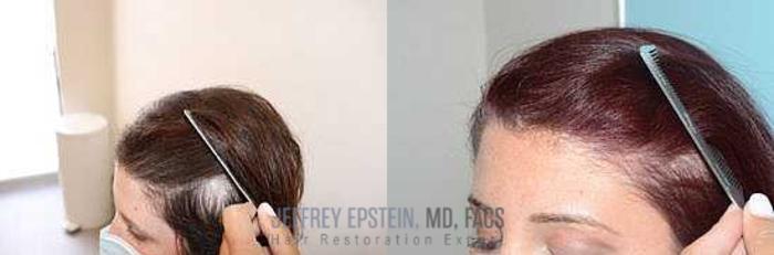 Before & After Hair Red Light Therapy Case 418 View 4 View in Miami, FL