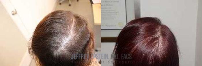 Before & After Hair Red Light Therapy Case 418 View 5 View in Miami, FL