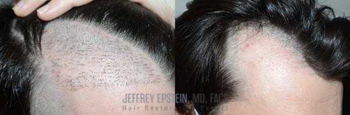 Before & After Hair Transplant Repair Case 101 View 1 View in Miami, FL