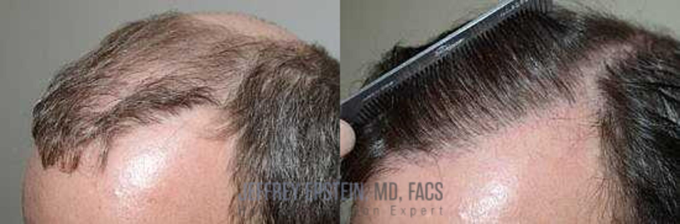 Before & After Hair Transplant Repair Case 112 View 2 View in Miami, FL