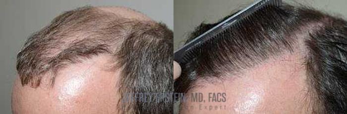 Before & After Hair Transplant Repair Case 112 View 2 View in Miami, FL