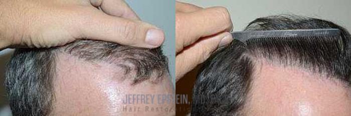 Before & After Hair Transplant Repair Case 112 View 3 View in Miami, FL