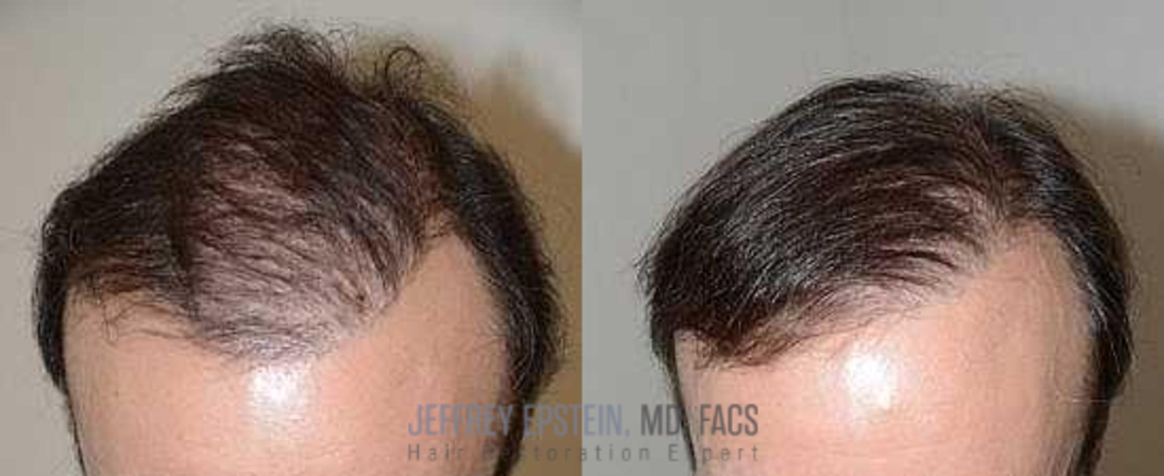 Before & After Hair Transplant Repair Case 125 View 1 View in Miami, FL