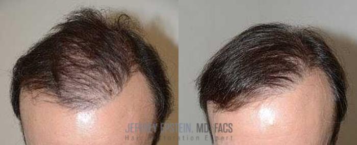 Before & After Body Hair Transplant (BHT) Case 125 View 1 View in Miami, FL