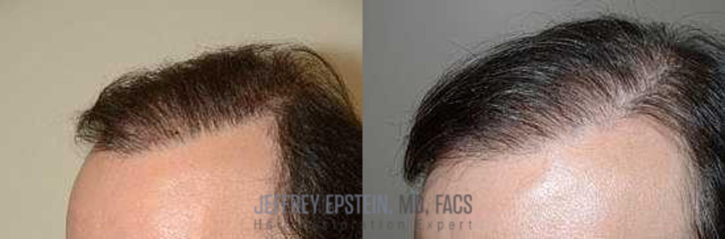 Before & After Hair Transplant Repair Case 125 View 2 View in Miami, FL