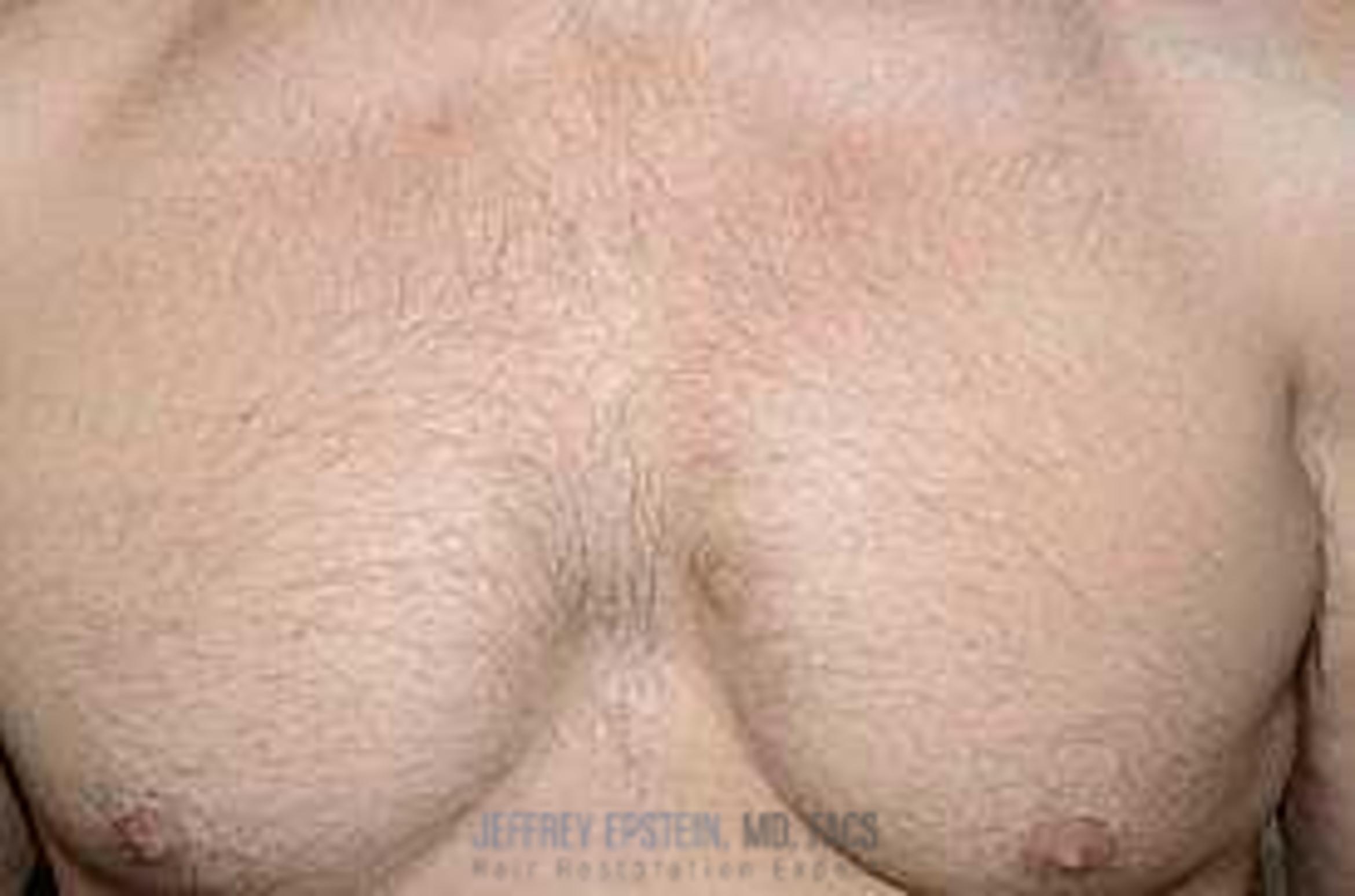 Before & After Hair Transplant Repair Case 125 View 3 View in Miami, FL