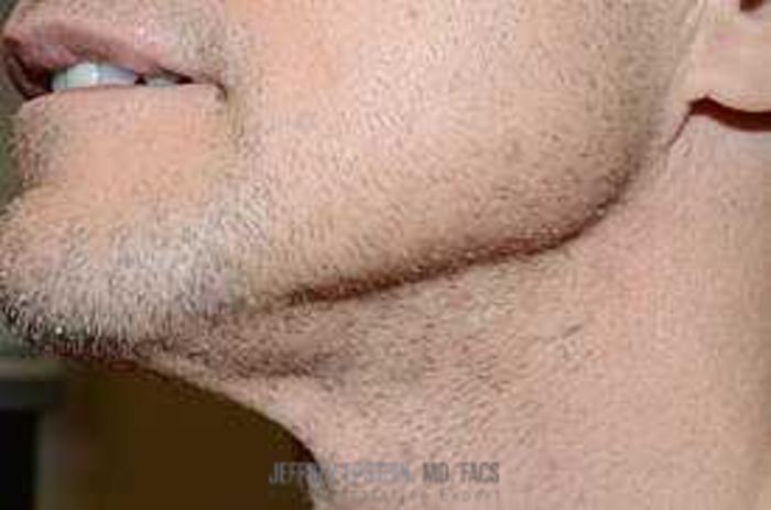 Before & After Hair Transplant Repair Case 125 View 4 View in Miami, FL