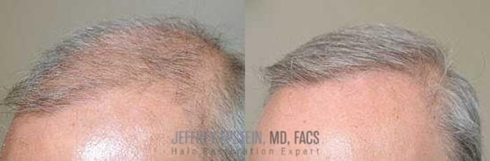 Before & After Body Hair Transplant (BHT) Case 126 View 1 View in Miami, FL