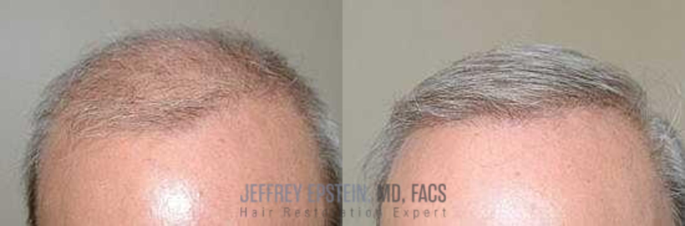 Before & After Hair Transplant Repair Case 126 View 2 View in Miami, FL