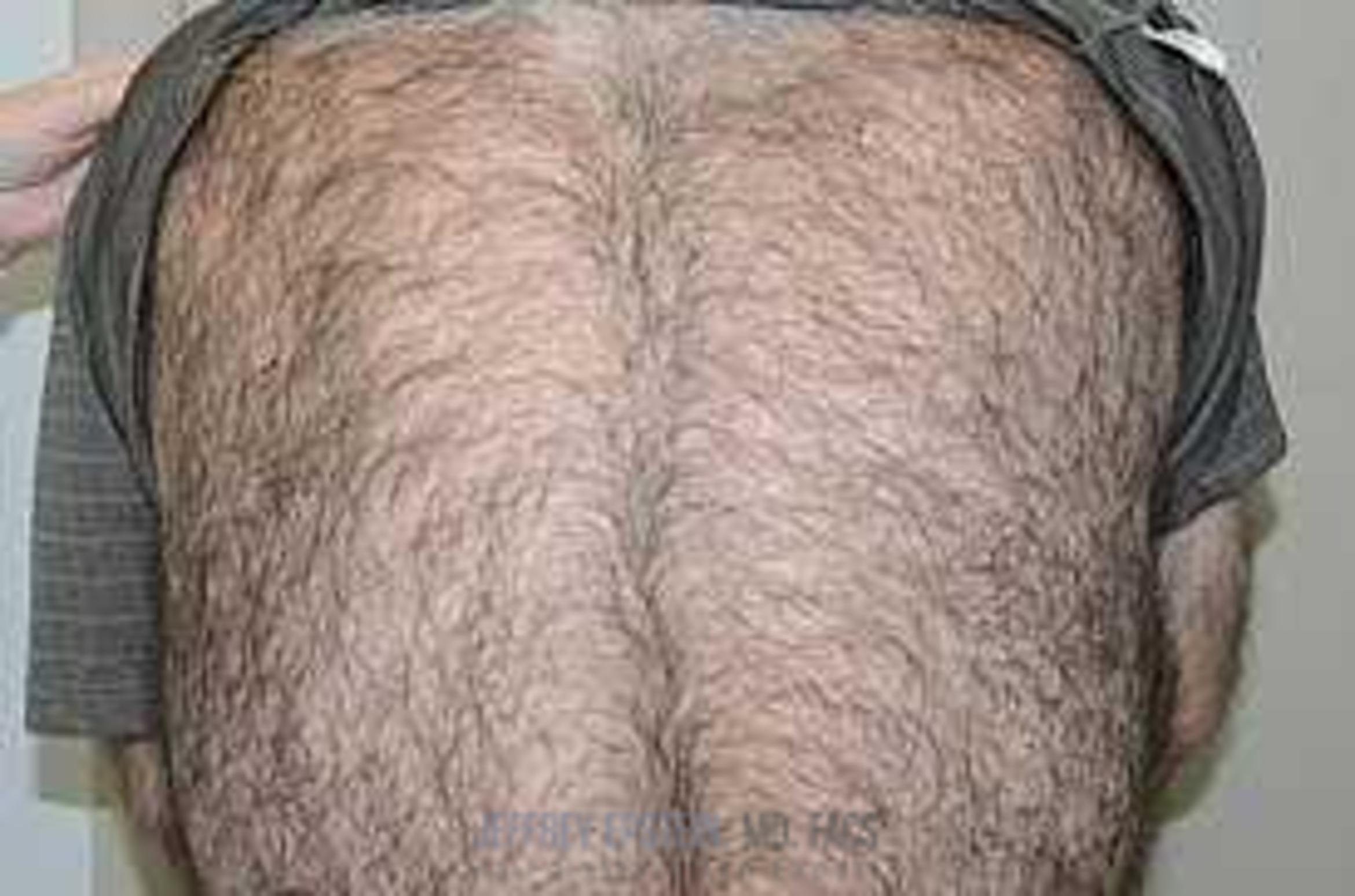 Before & After Hair Transplant Repair Case 126 View 3 View in Miami, FL