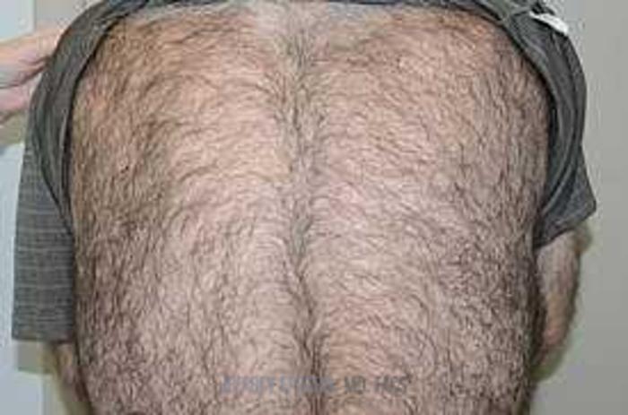 Before & After Hair Transplant Repair Case 126 View 3 View in Miami, FL