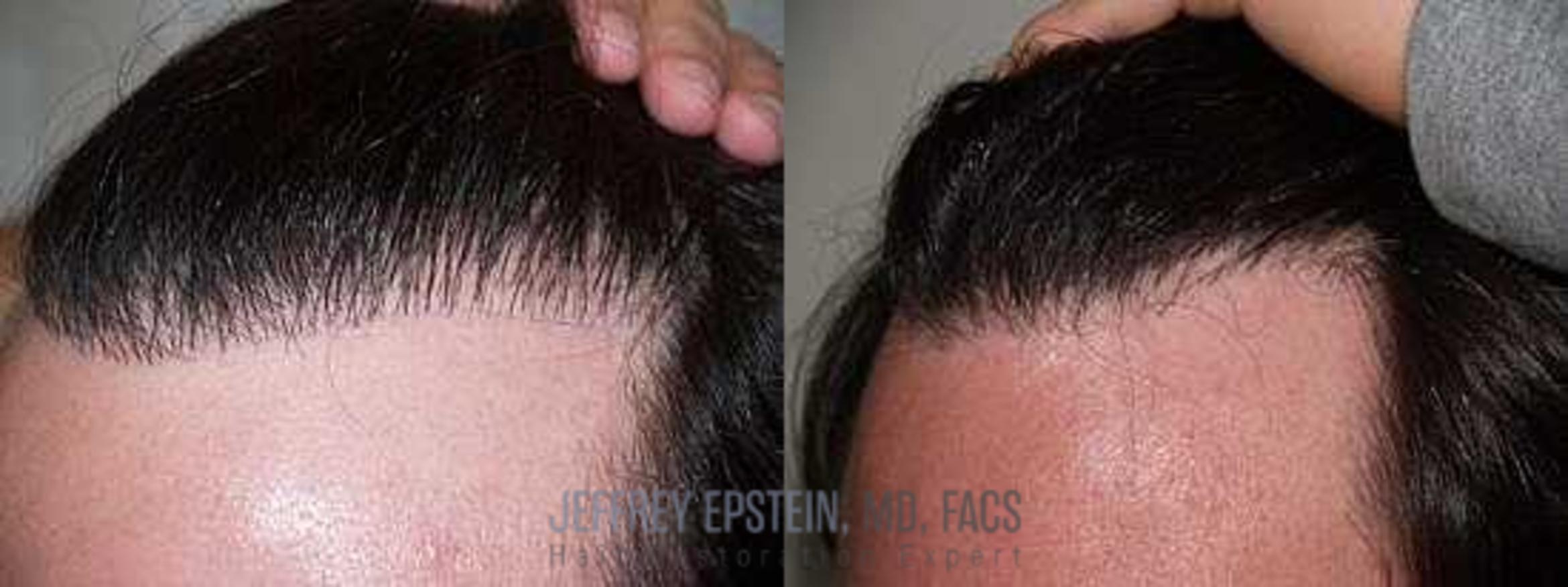 Before & After Hair Transplant Repair Case 131 View 1 View in Miami, FL