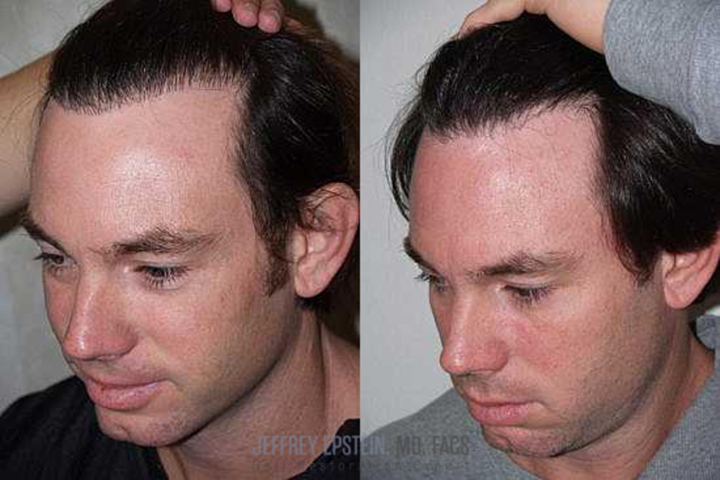 Before & After Hair Transplant Repair Case 131 View 2 View in Miami, FL