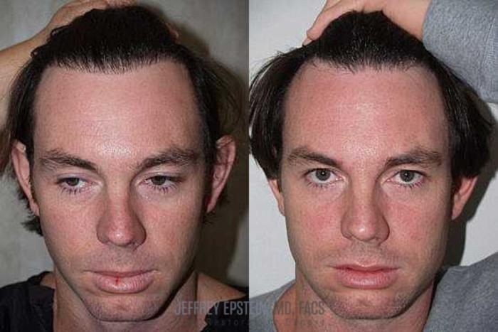 Before & After Hair Transplant Repair Case 131 View 3 View in Miami, FL