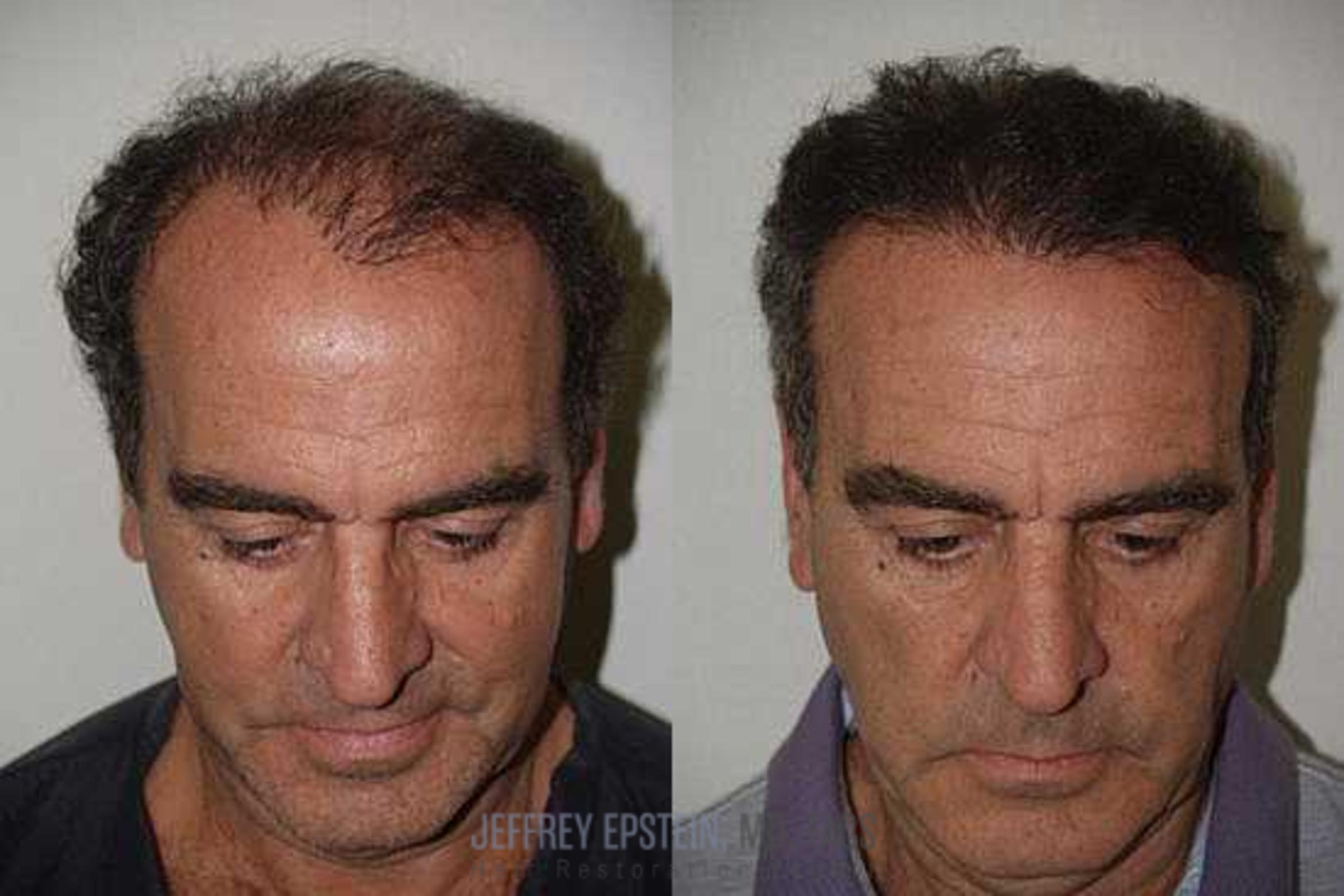 Before & After Hair Transplant Repair Case 137 View 2 View in Miami, FL