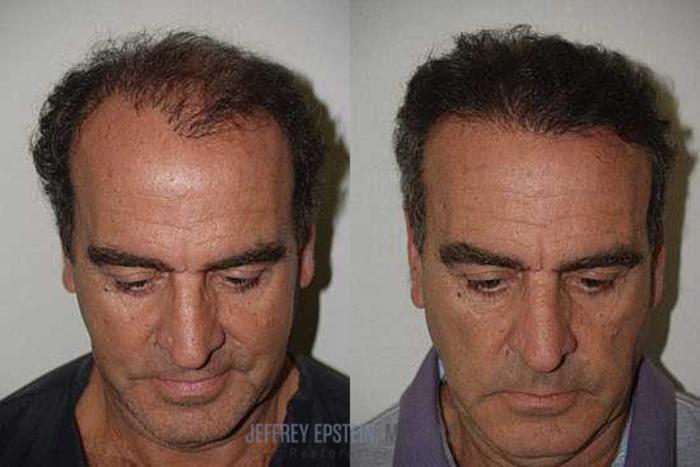 Before & After Hair Transplant Repair Case 137 View 2 View in Miami, FL