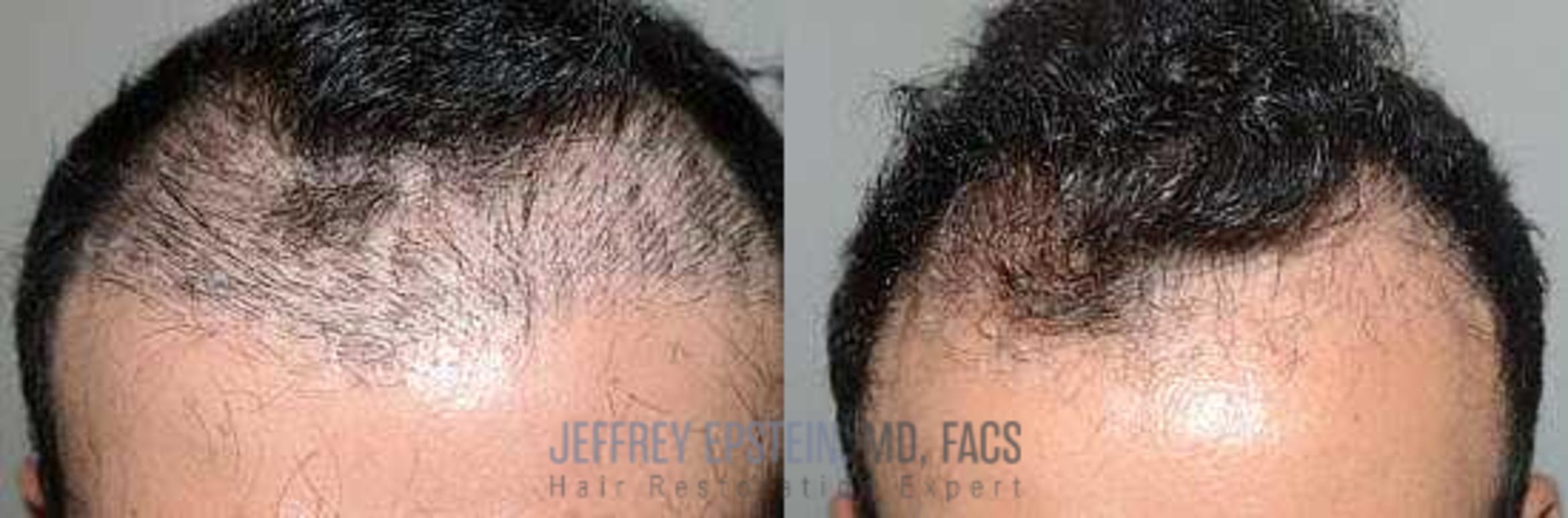 Before & After Hair Transplant Repair Case 14 View 2 View in Miami, FL